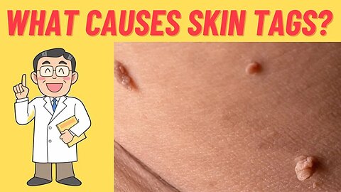 Goodbye Skin Tags: Transform Your Diet for Clearer Skin