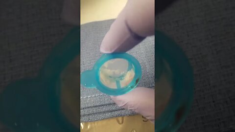 Strange Substance Sucked Out of Patient's Artery