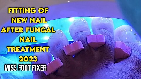 FITTING OF A NEW TOENAIL AFTER DOING FUNGAL NAIL TREATMENT BY FAMOUS PODIATRIST MISS FOOT FIXER