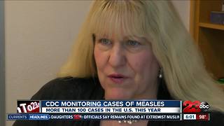 Cases of measles reported in CA, CDC monitoring