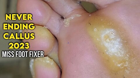 CALLUS EVERYWHERE ON FOOT 2023 [ NEVER ENDING CALLUS SCRAPING ] BY FOOT SPECIALIST MISS FOOT FIXER