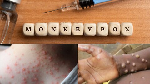 Symptoms of monkeypox. #monkeypox