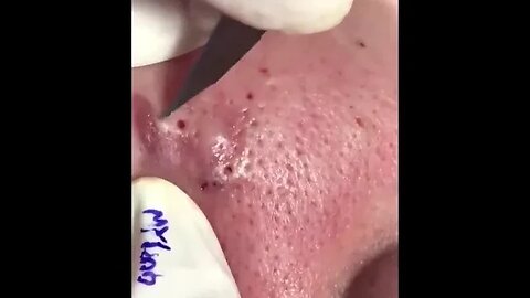 Pimple Popping Acne Treatment Blackhead Extraction