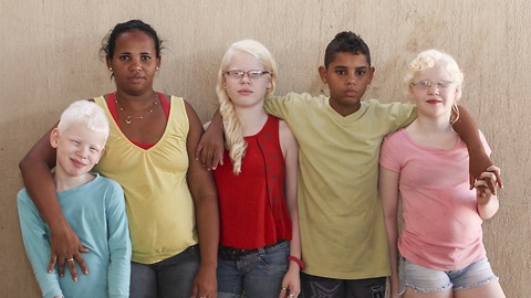 My Albino Children: Black Brazilian Family Have Three White-Skinned Children