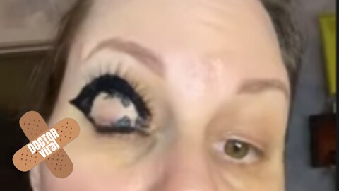 Fake Eyelashes Stick To Woman's Eyelid