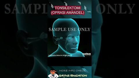 OPRASI AMANDEL (TONSILEKTOMI) #short #health #medical #tonsillectomy #tonsil #oprasi #sehat