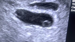 A single embryo SPLITS! Early identical twin findings at 5 & 6/7 weeks gestation.