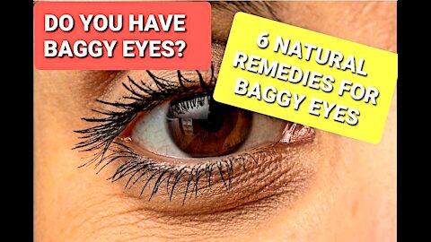 6 Natural Remedies For Baggy Eyes