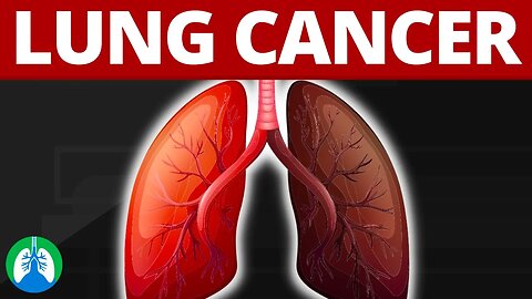 What is Lung Cancer? (Medical Definition)