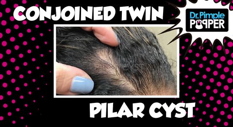 "Conjoined Twin" Pilar Cyst