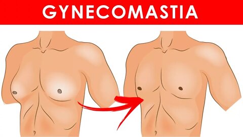 Home Remedies for Gynecomastia (Enlarged Breasts in Men)