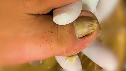 Manicure Unclogging the toenail Solve your problem #7 | 2022 Video