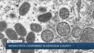 Kenosha County reports first case of monkeypox, marks 12th case in Wisconsin