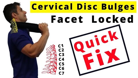 Cervical Disc Bulge and Cervical Facet Lock pain Relief