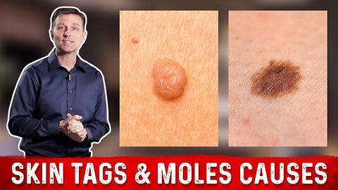 What Causes Skin Tags and Moles? – Dr.Berg