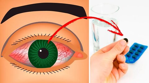 How To Cure a Pink Eye Naturally