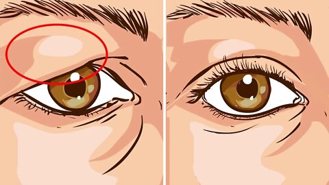 How To Treat Droopy Eyelids Naturally... The Results Are Amazing!