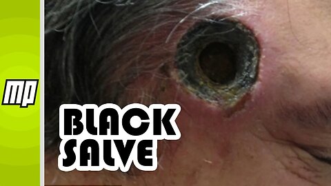 Black Salve - Cancer 'Treatment' That Burns Holes in You!