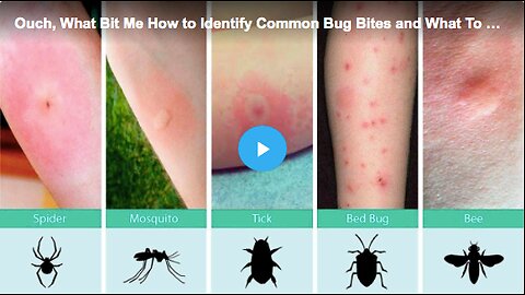 Learn how to identify common bug bites and what to do about them