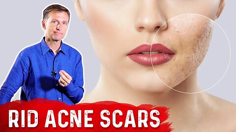 Best Way to Rid Acne Scars