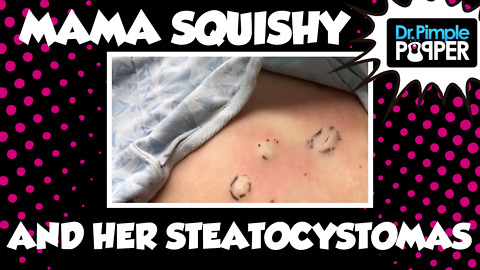 Momma Squishy & Her Happy Steatocystomas!