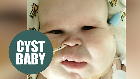 Baby born with cysts covering half of his face