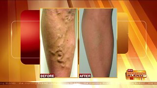 Advancements in Treating Vein Disease