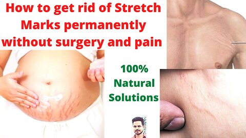 How to get rid of stretch marks permanently without any surgery and pain-100% solutions