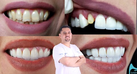 Hollywood Smile from Dr.Ahmad Abu Easha