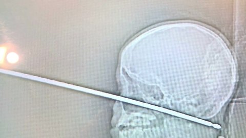 Boy survives falling onto meat skewer