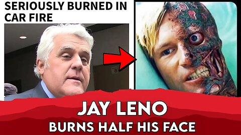 Jay Leno Nearly Dies in Car Fire That Burns Half Of His Face | Famous News