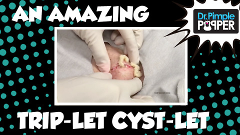 An AMAZING Trip-let Cyst-let!