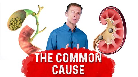 Gallstones vs Kidney Stones: A Common Cause of Kidney Stones & Gallstones – Dr.Berg