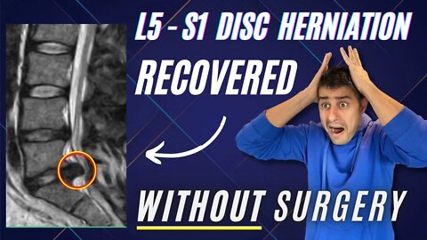 L4 L5 - L5 S1 disc herniation recovered pain free without surgery