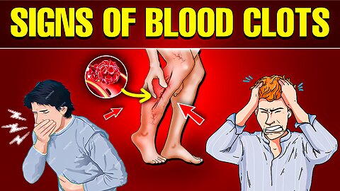BEWARE! 9 Warning Signs of Blood Clots