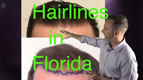 Hairline Hair Transplants in Florida - Dr. Nusbaum 1 Year Review