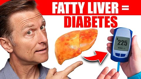 Your Fatty Liver Caused Your Diabetes