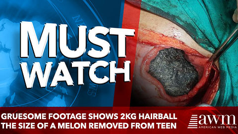 Gruesome footage shows 2kg hairball the size of a MELON