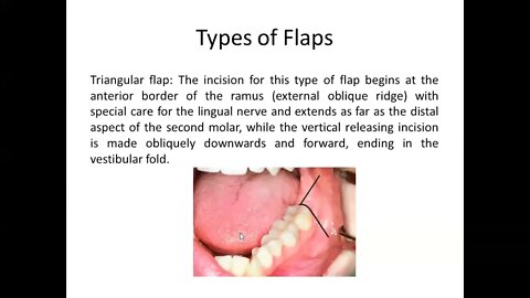 Oral surgery L19 part2 (Surgical extraction of impacted teeth)