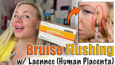 Bruise Flushing with Laennec (Human Placenta) AceCosm | Code Jessica10 saves You Money!