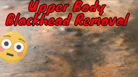 Upper body blackheads removal 😳 so many #blackheadremoval #blackhead #blackheads #blackheadsremoval