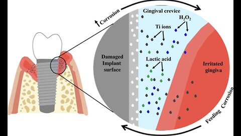 Warning! Titanium Dental Implants Trigger Electrochemical Inflammation