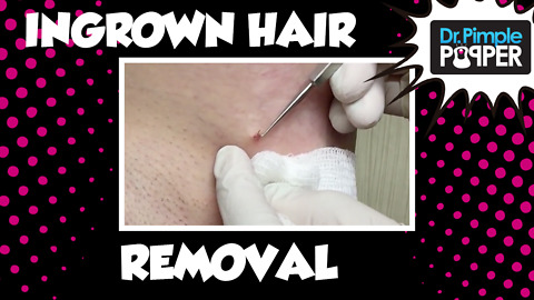 Dr. Pimple Popper Ingrown Hair Removal