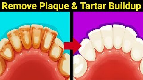 9 Natural Ways to Remove Plaque & Tartar Buildup