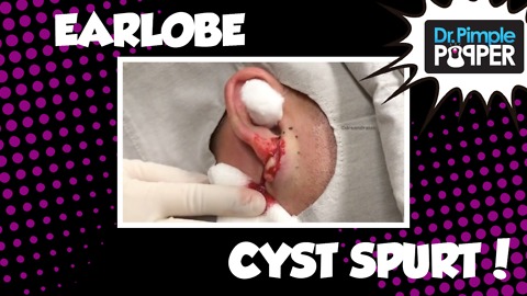 Dr Pimple Popper: Splash Screen Required for this Earlobe Cyst!