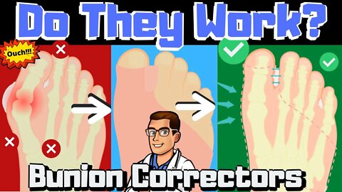 Do Bunion Correctors Work? [How To SHRINK Bunions Naturally!]