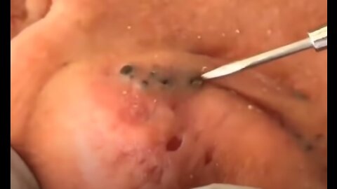 Zit Zappin Pimple Popper Blackhead Blasting