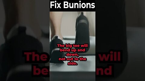 What Causes a Bunion? THE REAL CAUSE! [What is a Bunion? For REAL]