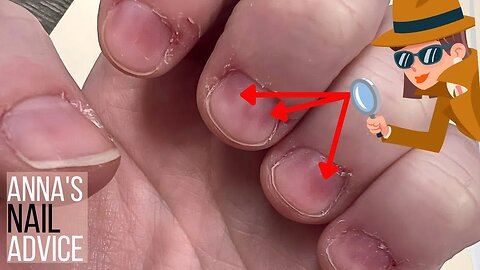 What are these red patches on the nails?! [Anna's Nail Advice]