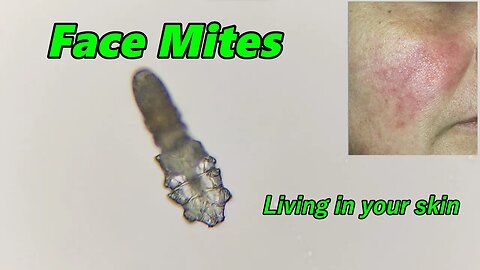 Demodex (Face Mites) Living in your Skin